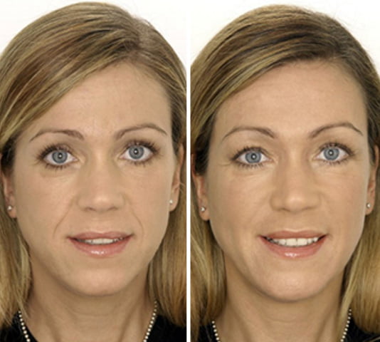 Collagen Select before after 1