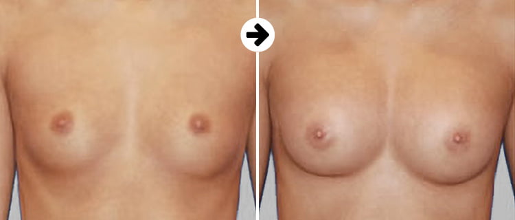 Breastfast before after 2